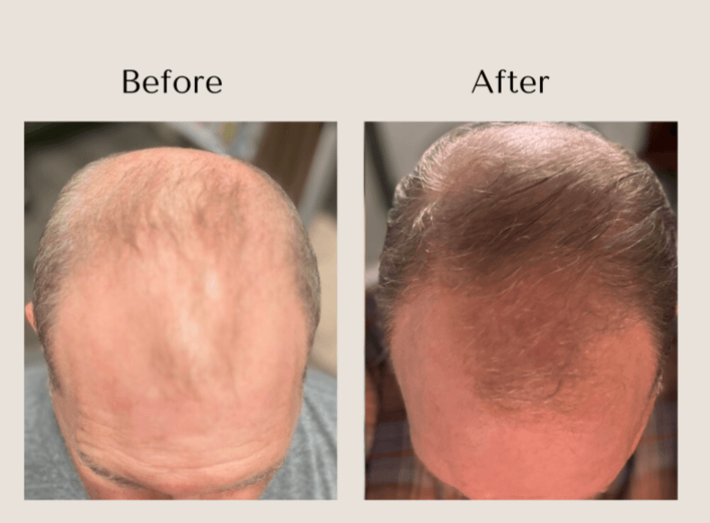 TED Hair Restoration before and after showing improved density and coverage through the frontal hairline in a man with thinning hair at Root Revival Hair Restoration in Cumming, GA.
