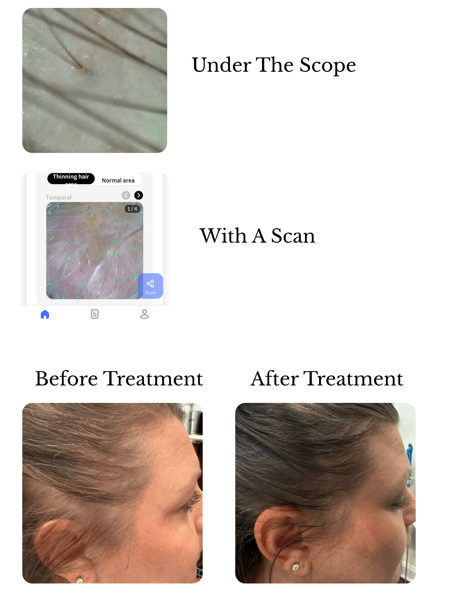 Hair & Scalp Evaluation for Telogen Effluvium with trichoscopy, digital hair density analysis, and before-and-after progress photographs
