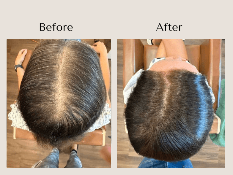 TED Hair Restoration before and after showing improved hair density and reduced scalp visibility along the part at Root Revival Hair Restoration in Cumming, GA.