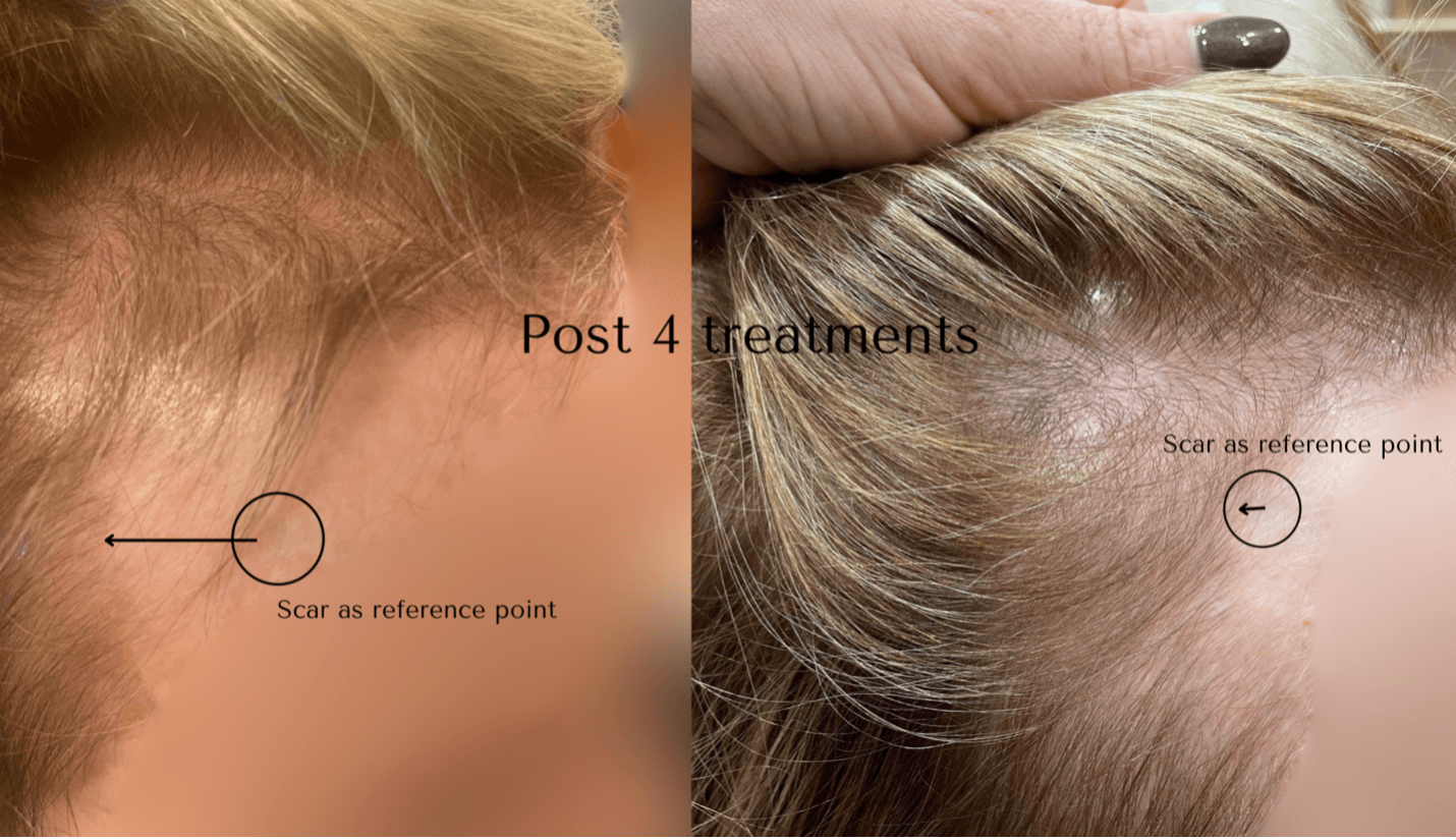 Frontal hairline thinning improvement documented by a board-certified trichologist following Alma TED hair restoration treatments