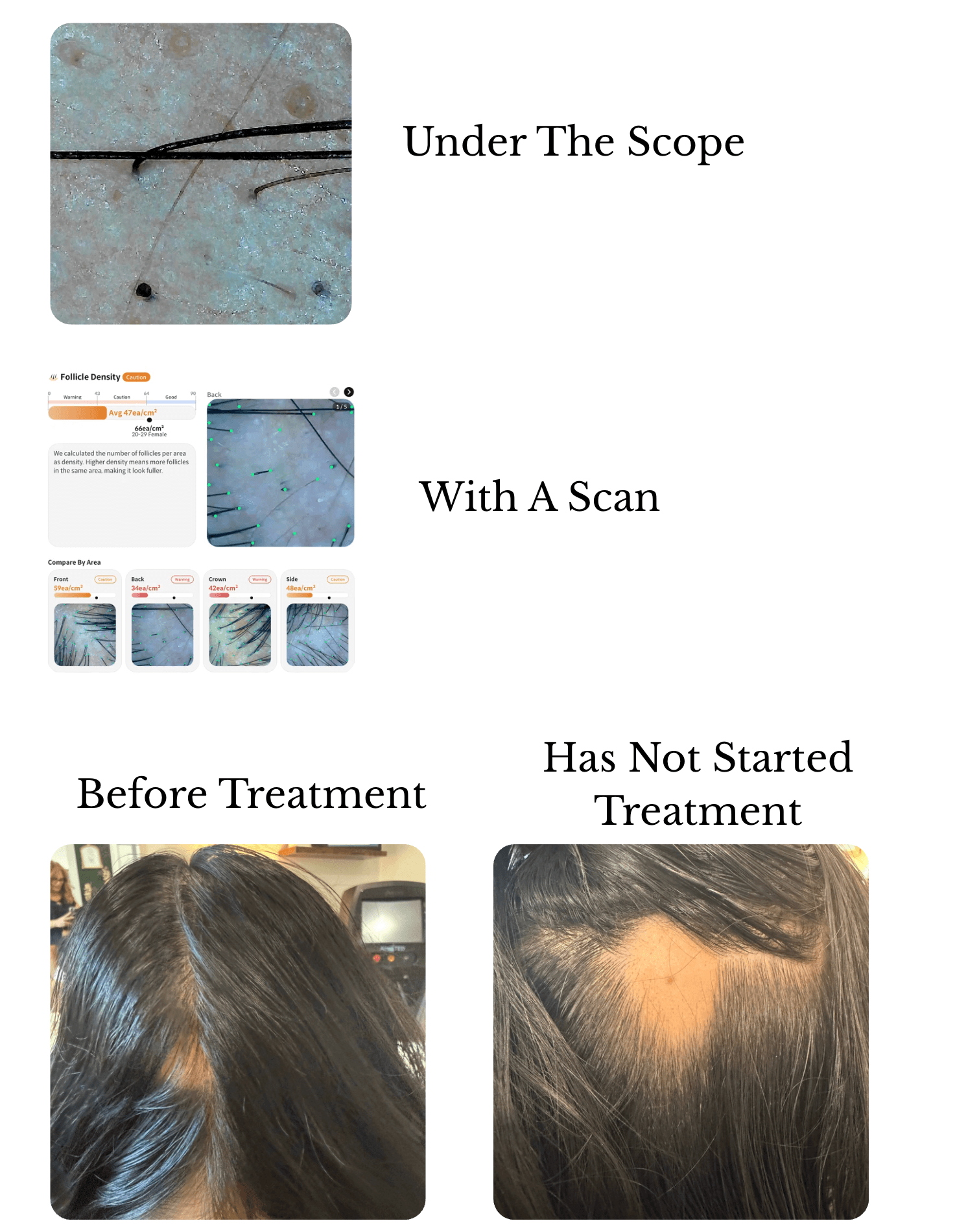 Alopecia Areata Hair & Scalp Evaluation with trichoscopy, digital scalp imaging, and clinical photographs before treatment.