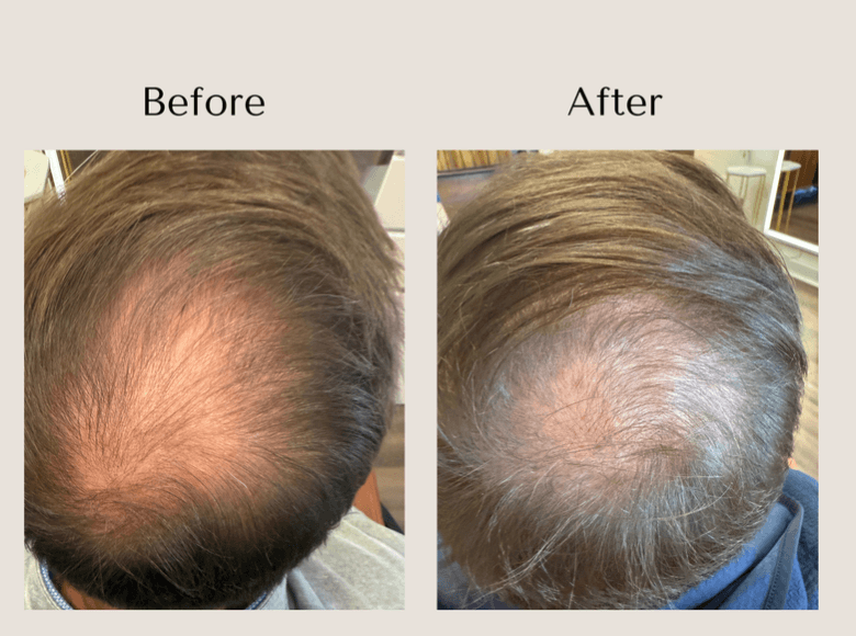 TED Hair Restoration before and after showing improved hair density and scalp coverage at the crown at Root Revival Hair Restoration in Cumming, GA.
