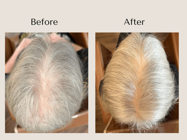 TED Hair Restoration before and after showing improved hair density and reduced scalp visibility along a widening part at Root Revival Hair Restoration in Cumming, GA.
