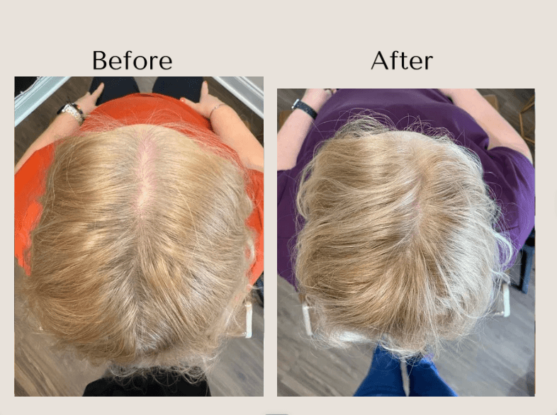 TED Hair Restoration before and after showing improved hair density and reduced scalp visibility along the part in a woman with thinning hair at Root Revival Hair Restoration in Cumming, GA.