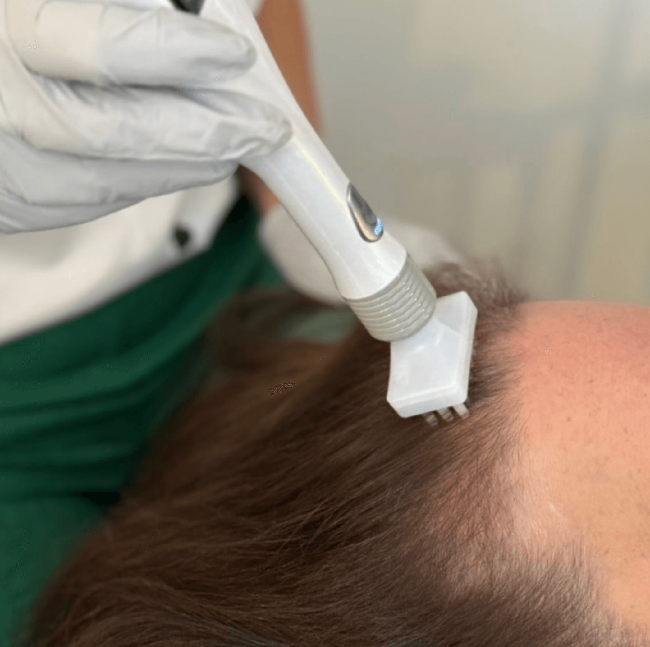 Close up view of Cold Root Plasma being applied during a professional hair and scalp treatment at Root Revival Hair Restoration in Cumming Georgia serving Forsyth County