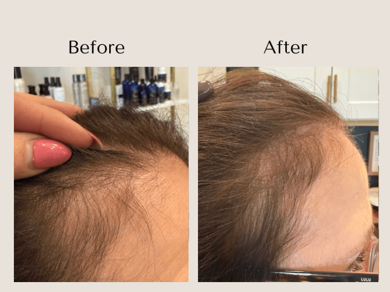 TED Hair Restoration before and after showing improved hair density and coverage along the female temple and frontal hairline at Root Revival Hair Restoration in Cumming, GA.