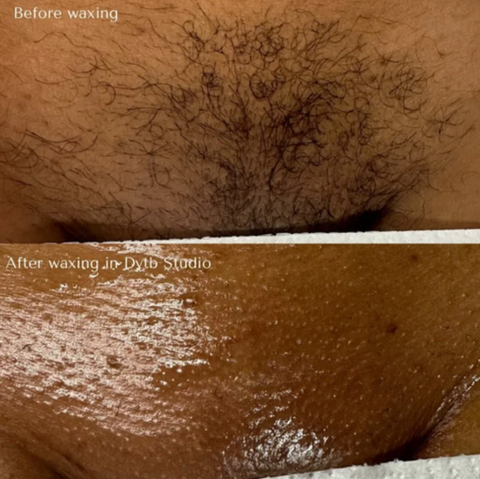 Comparison of body hair before and after waxing, showing a hairy male lower abdomen and pubic area above and smooth, hairless skin below after waxing.