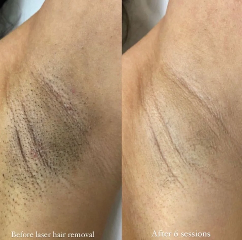 Comparison of armpit hair removal, showing hair before laser hair removal and after six sessions, with significantly less hair and smoother skin on the right side.