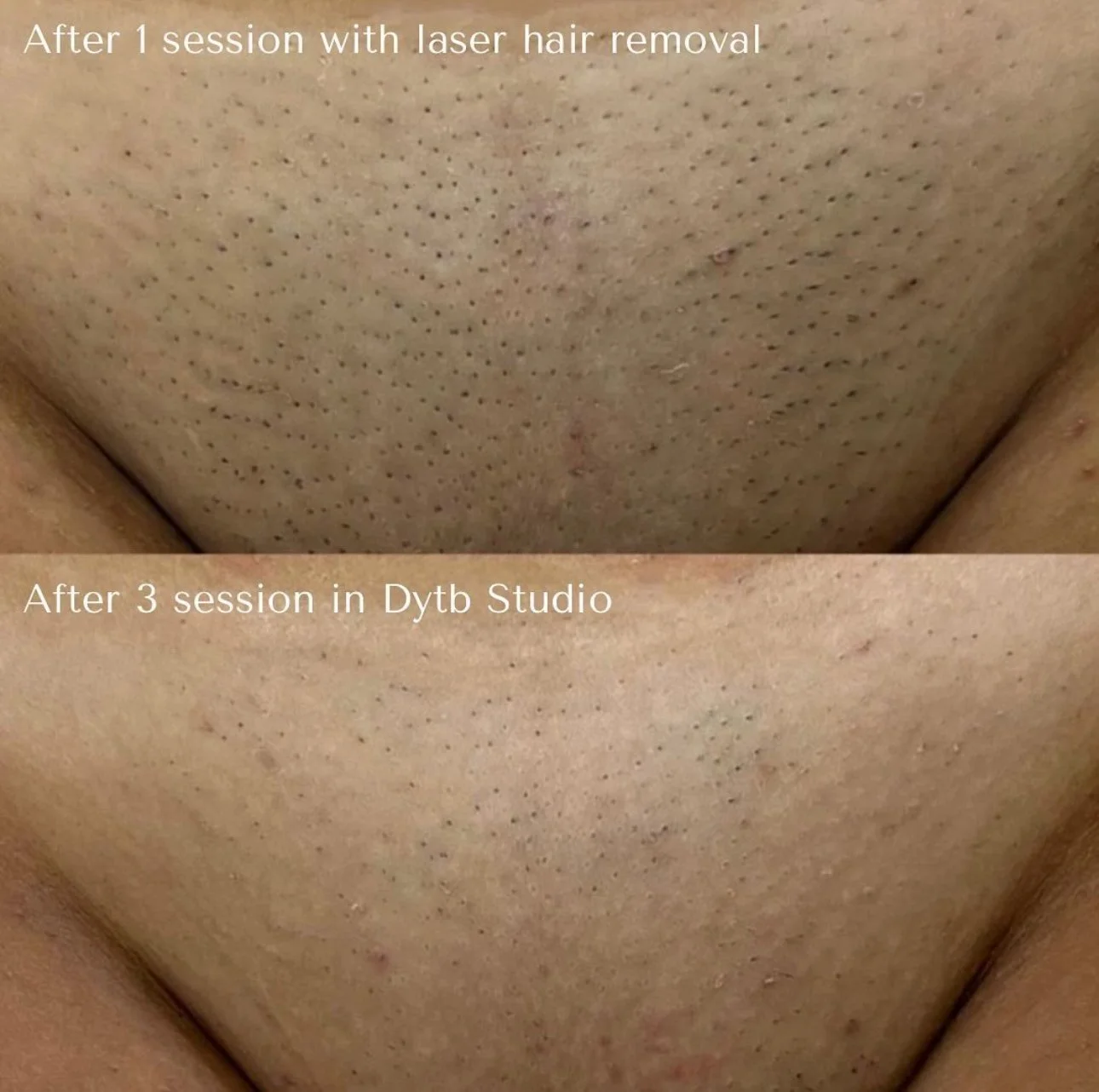 Comparison of skin before and after laser hair removal sessions, showing reduced hair density and smoother skin.