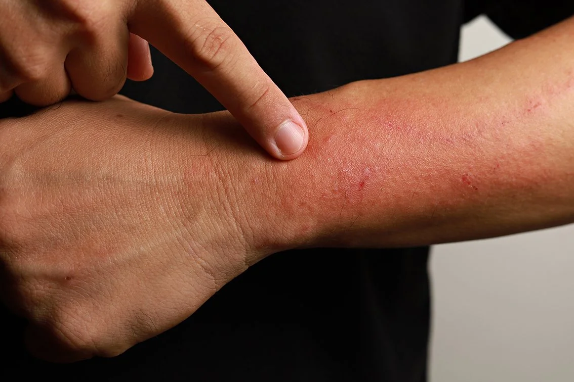 eczema rash treatment Brisbane your dermatologist Dr Zachary Boyce