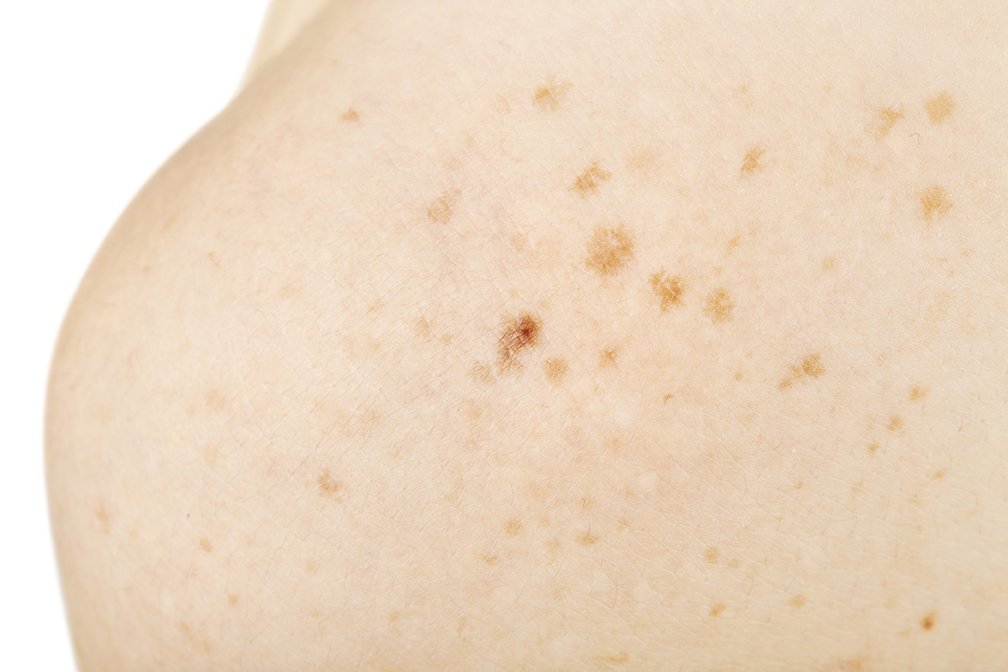 Sun spots Brisbane Your Dermatology Dr Zachary Boyce