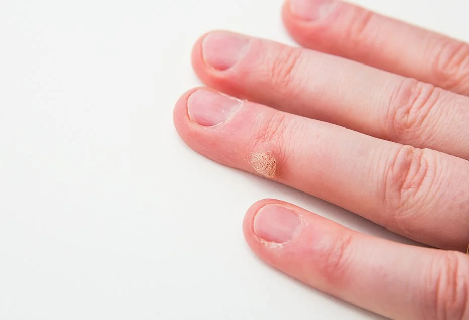 wart treatment brisbane your dermatologist