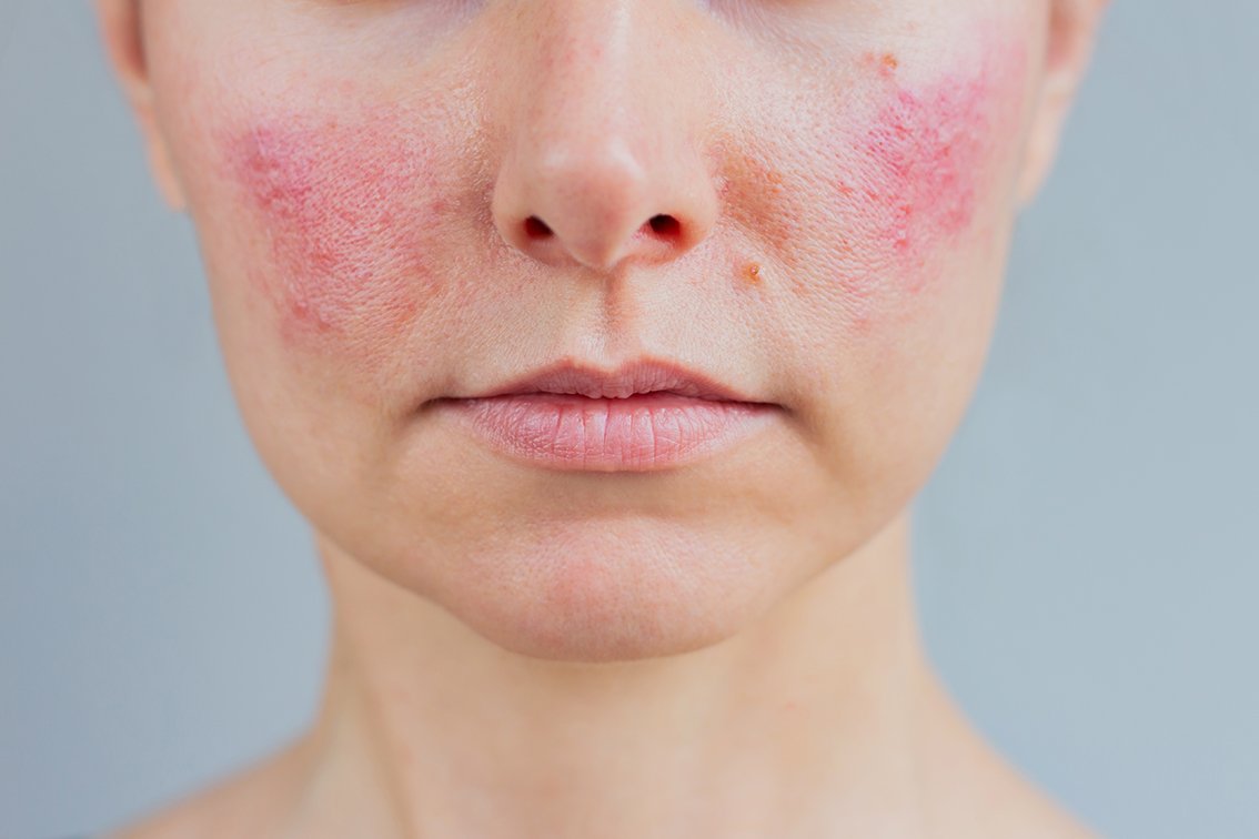 Rosacea treatment laser brisbane dermatology your derm Dr Zac Boyce