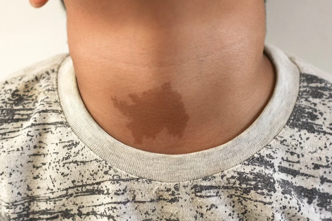 birthmark removal Brisbane your dermatologist