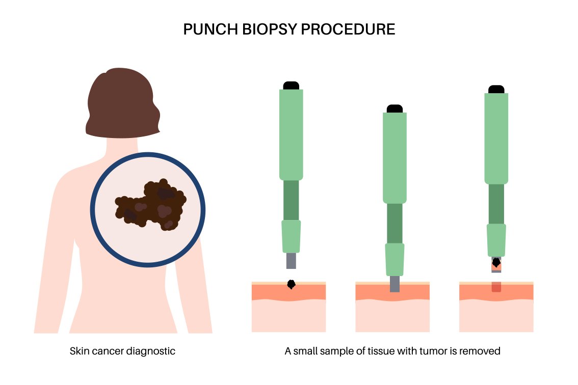 punch biopsy surgical derm Your Derm Brisbane