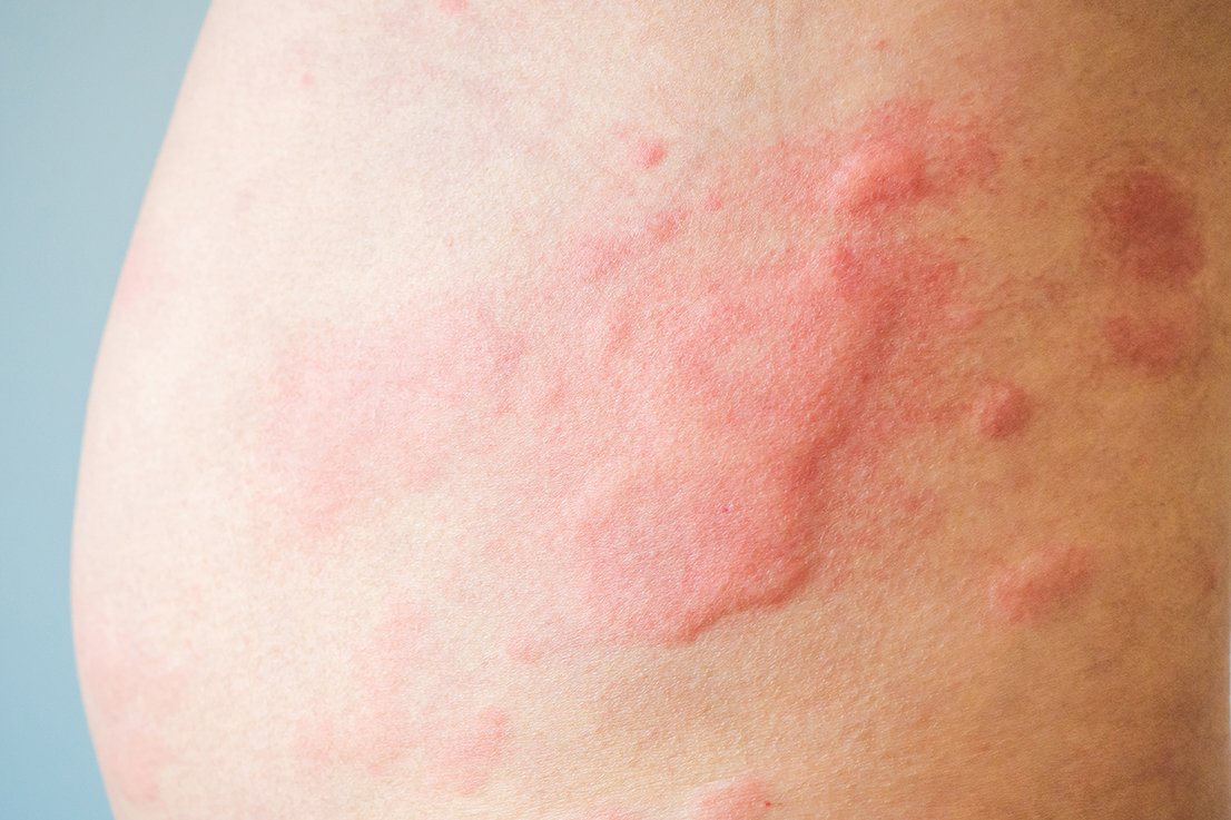 Hives rash treatment urticaria brisbane your dermatologist