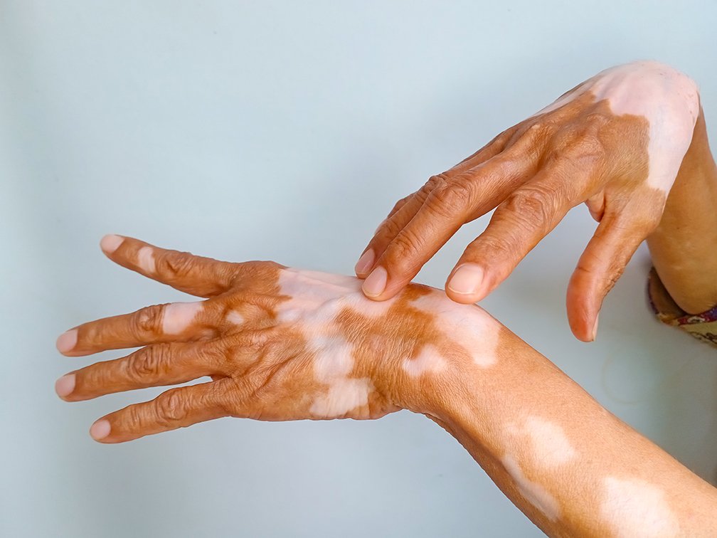 vitiligo treatment Brisbane your dermatologist