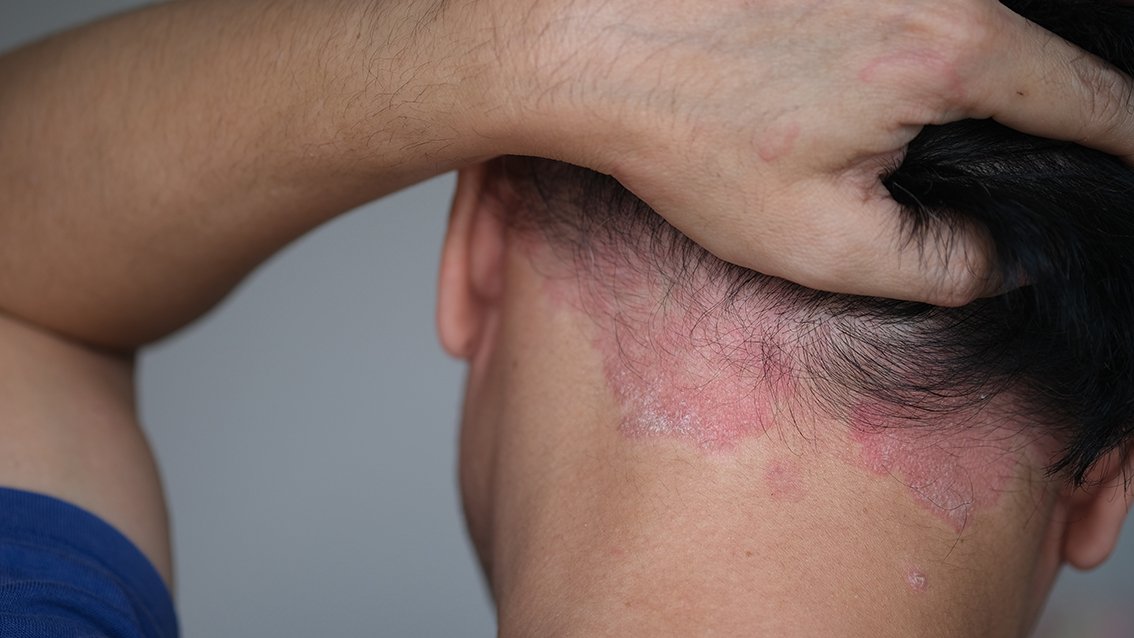 Psoriasis treatment Brisbane Your Dermatologist Dr Zac Boyce