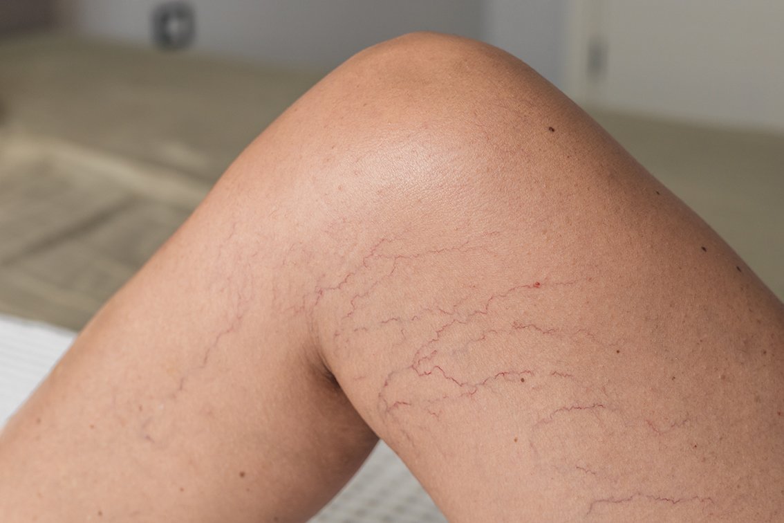 Leg vein treatment laser Brisbane dermatology Your Derm