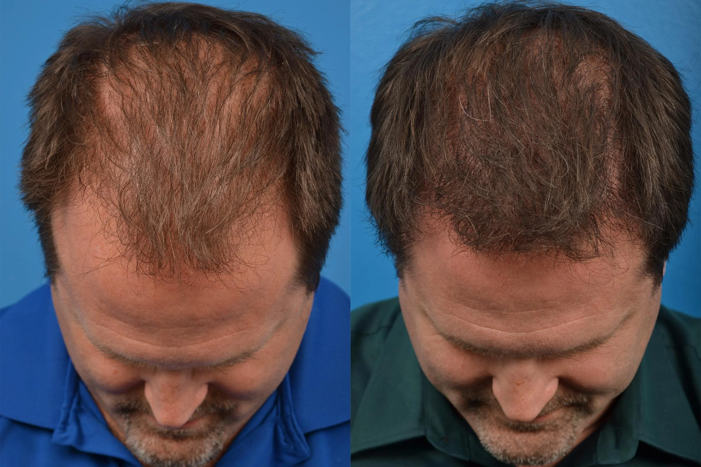 Hair Restoration