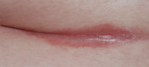 Bild einer Psoriasis inversa am After