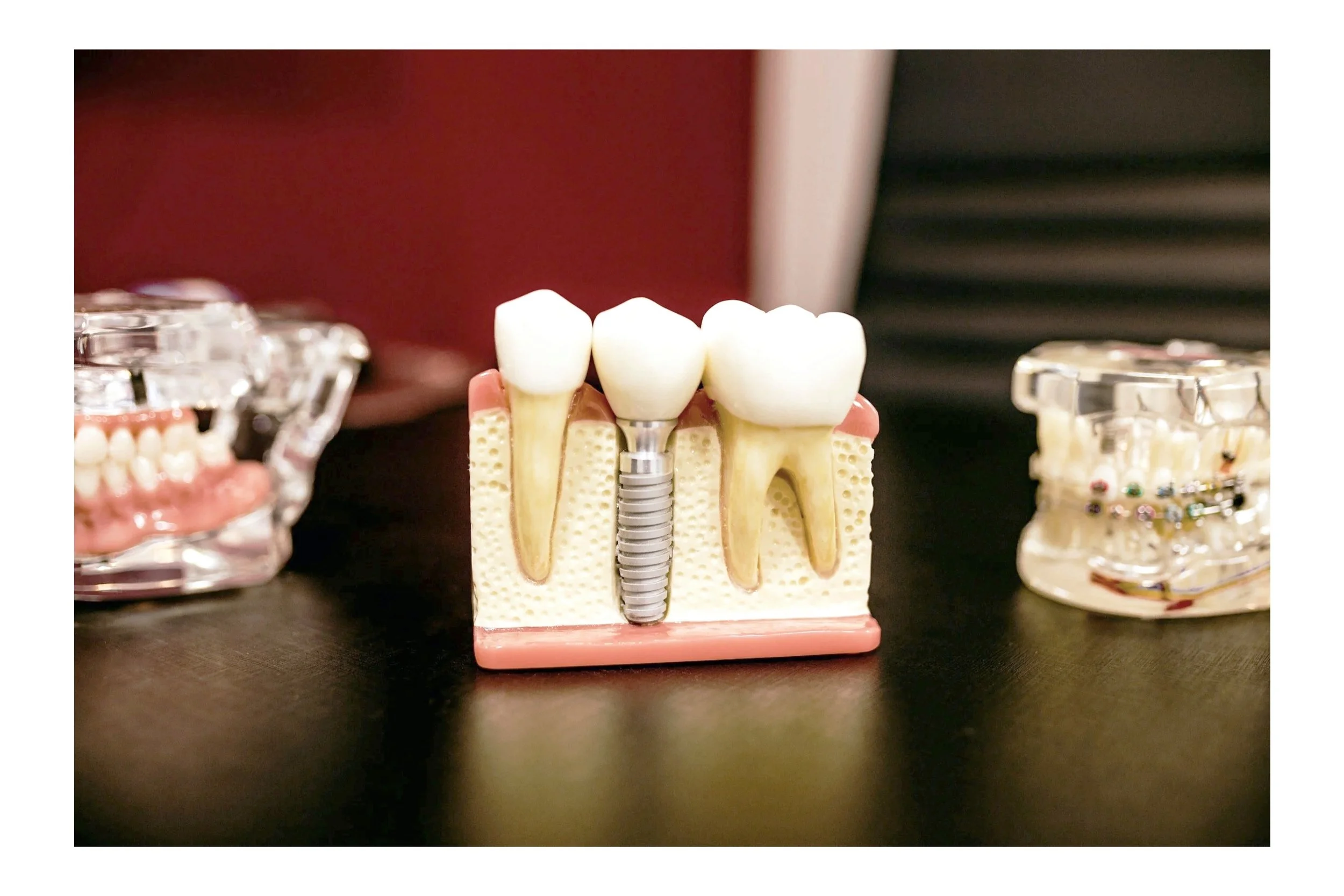 Dental model showing a dental implant between natural teeth with crowns, surrounded by other dental models on a dark surface.