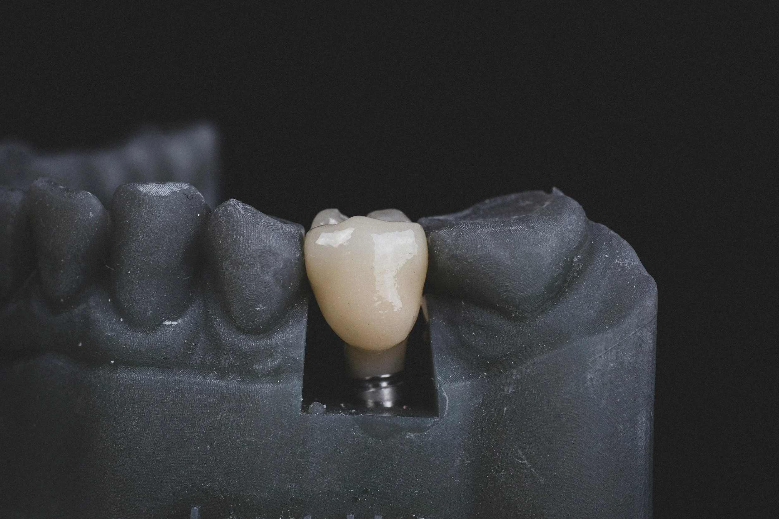 A dental model showcasing a single tooth with a dental crown in the center, surrounded by a black background.