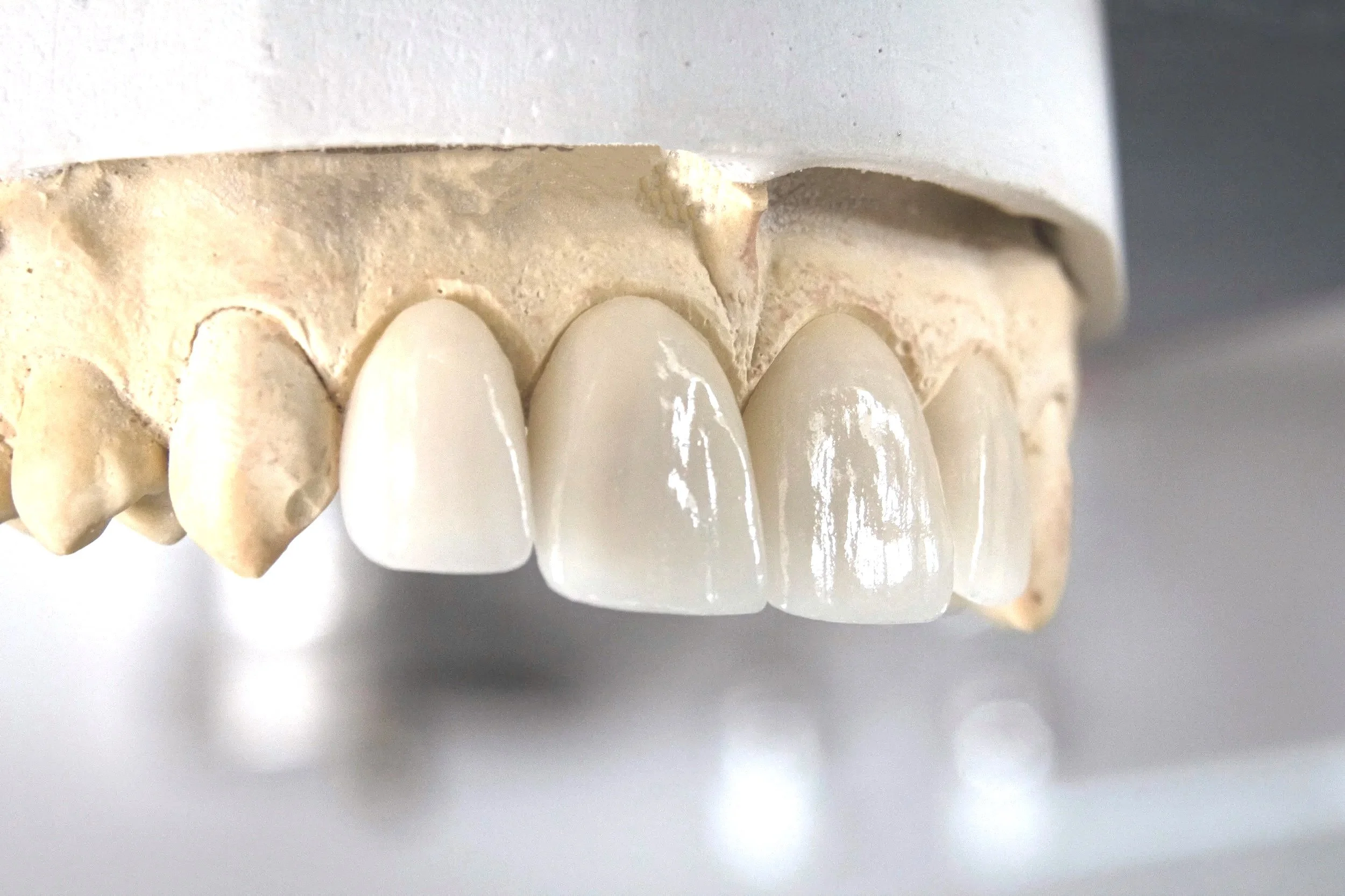 Dental model showing restored front teeth, including crowns or veneers.