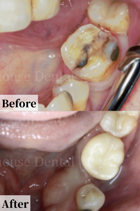 Case #1: Close-up of a person's lower molars before and after dental treatment, showing removal of decayed tooth and placement of a dental filling or crown.