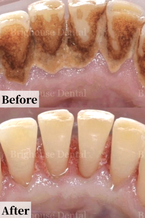 Case #2: Close-up of human teeth before and after dental cleaning. Upper teeth show heavy tartar buildup, lower teeth are clean.