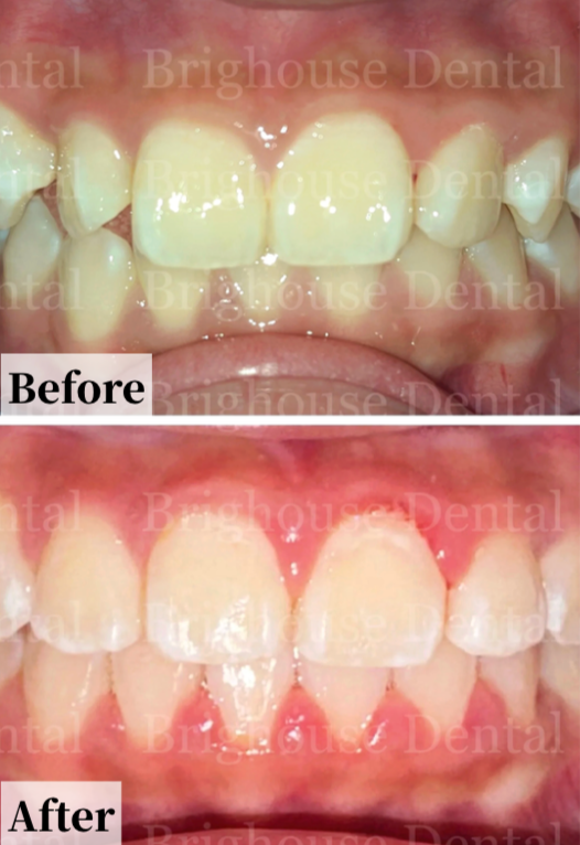 Case #3: Comparison of teeth before and after dental treatment, showing improved alignment and cleanliness.