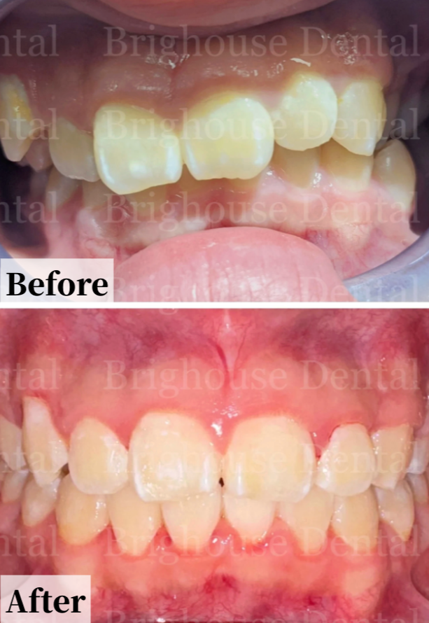 Case #4: Before and after photos of dental correction showing improved alignment of upper and lower teeth.