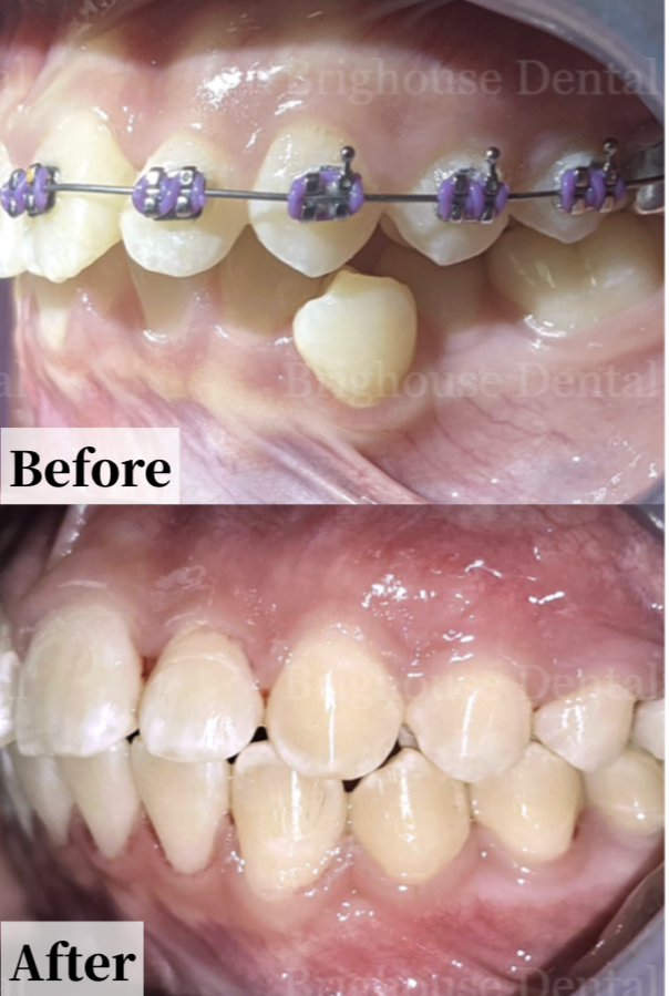 Case #5: Close-up of a person's upper and lower teeth with braces and ceramic brackets on the upper teeth. The lower teeth are natural without braces.