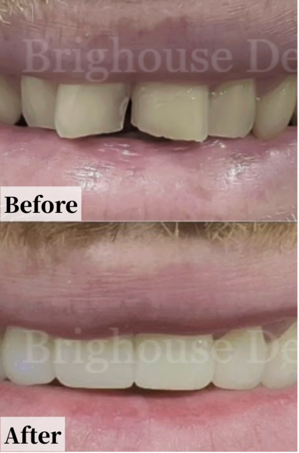 Case #6: Close-up of a person's mouth before and after dental treatment, showing improved teeth alignment and appearance.