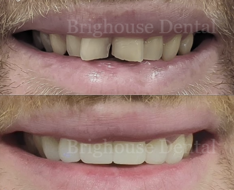 Close-up of a person's mouth before and after dental treatment, showing improved teeth alignment and appearance.