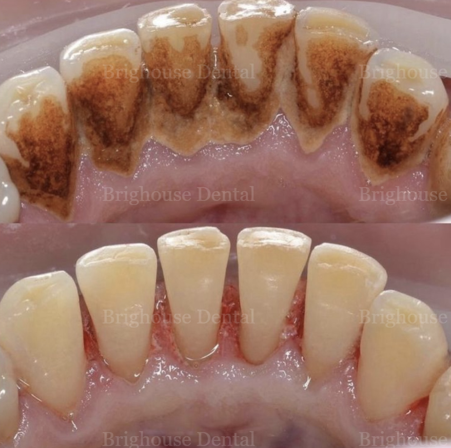 Close-up of human teeth before and after dental cleaning. Upper teeth show heavy tartar buildup, lower teeth are clean.