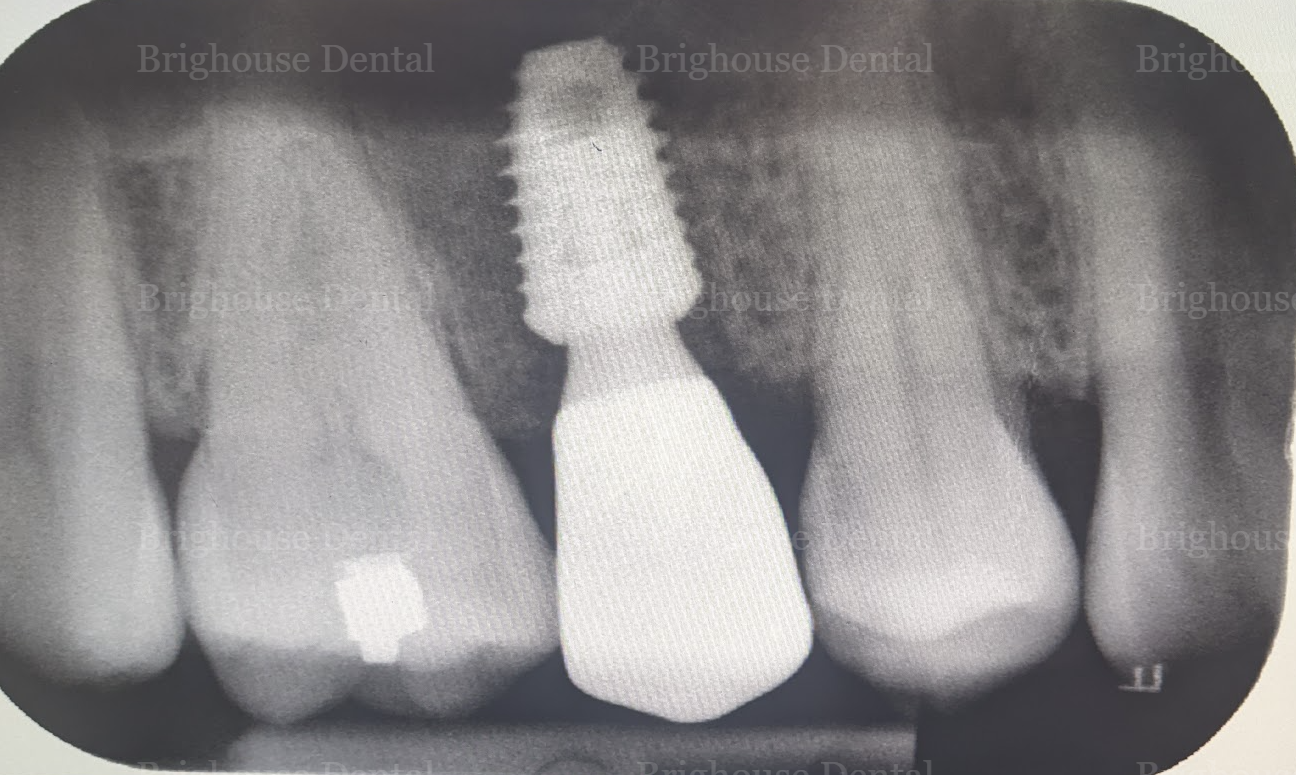 X-ray image showing implant placement of missing teeth