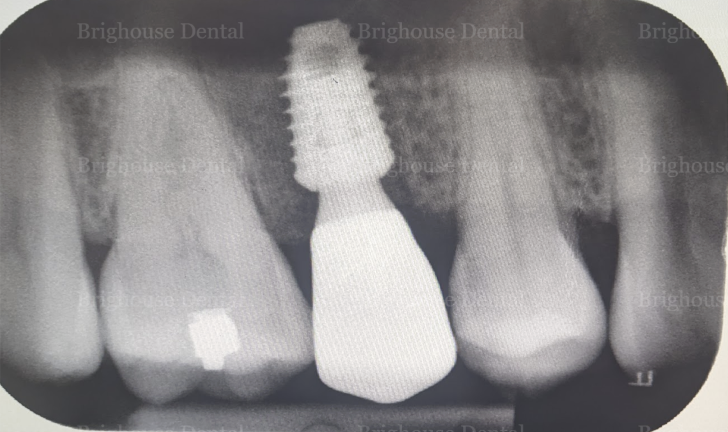 Case #8: X-ray image showing implant placement of missing teeth