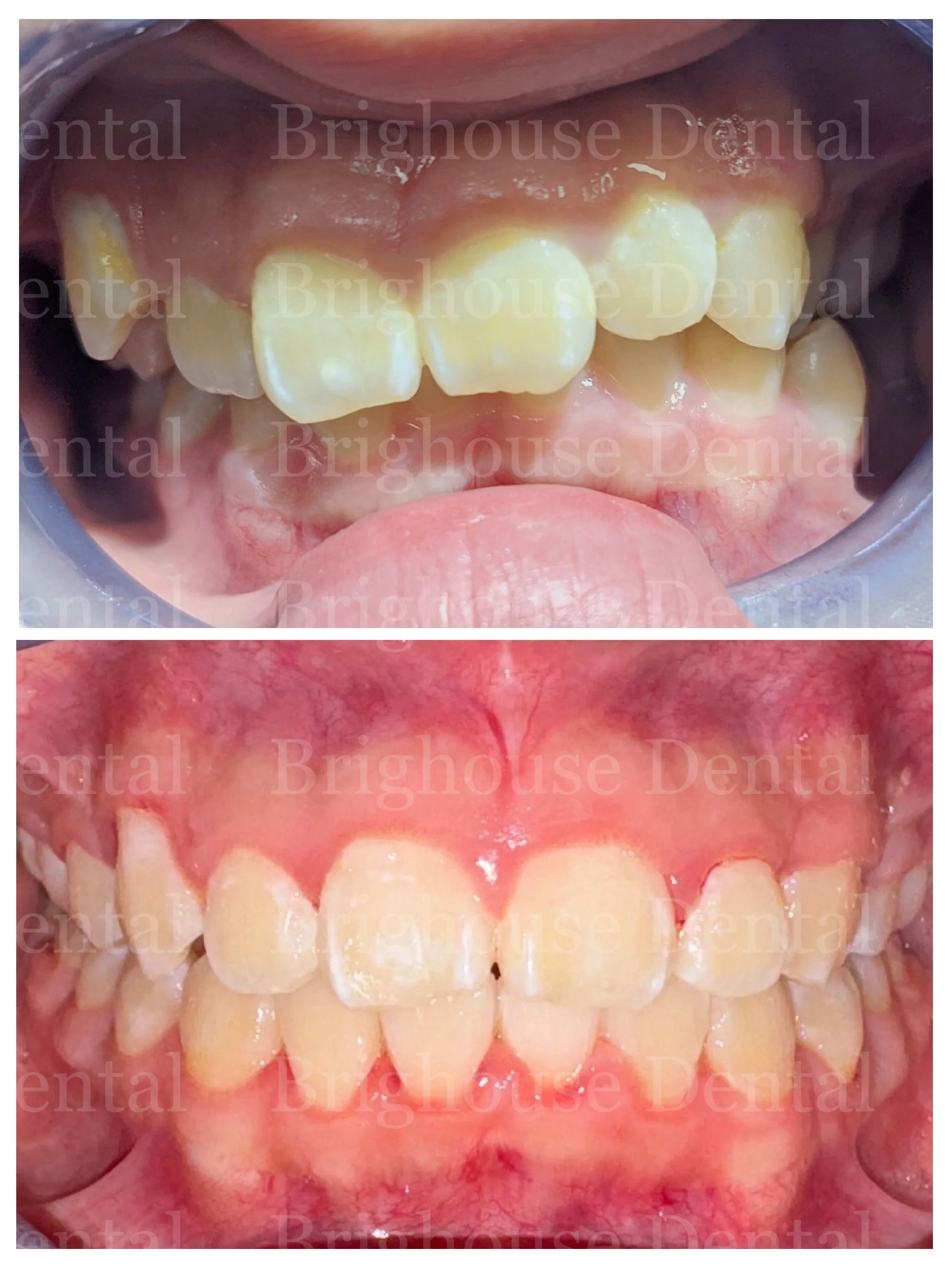 Before and after photos of dental correction showing improved alignment of upper and lower teeth.