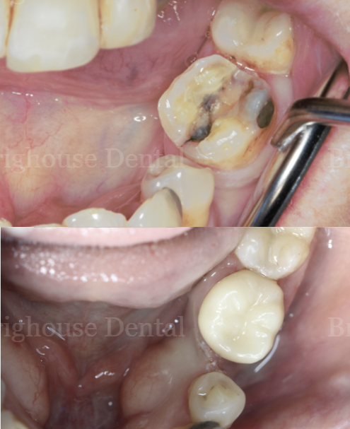 Close-up of a person's lower molars before and after dental treatment, showing removal of decayed tooth and placement of a dental filling or crown.