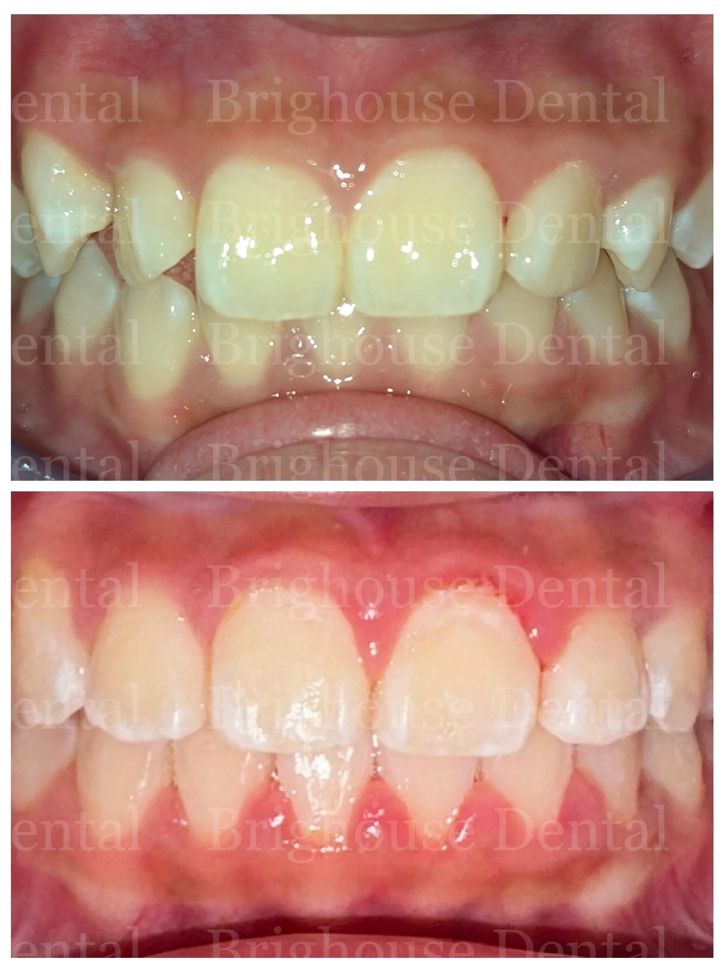 Comparison of teeth before and after dental treatment, showing improved alignment and cleanliness.