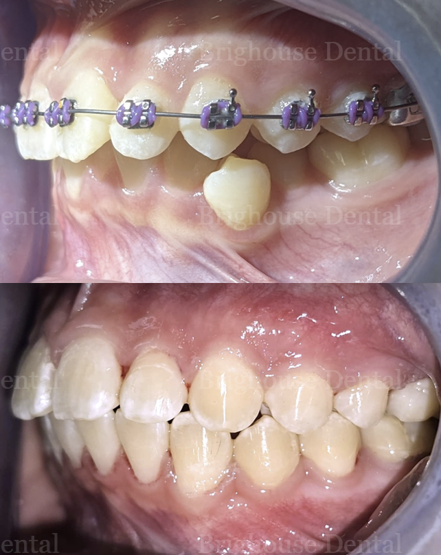 Close-up of a person's upper and lower teeth with braces and ceramic brackets on the upper teeth. The lower teeth are natural without braces.