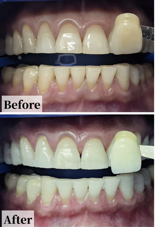 Case #7: Comparison of teeth before and after teeth whitening treatment.