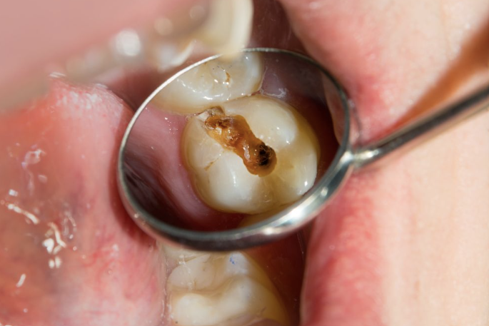 Close-up of a molar tooth with visible cavities, being examined with a dental mirror.