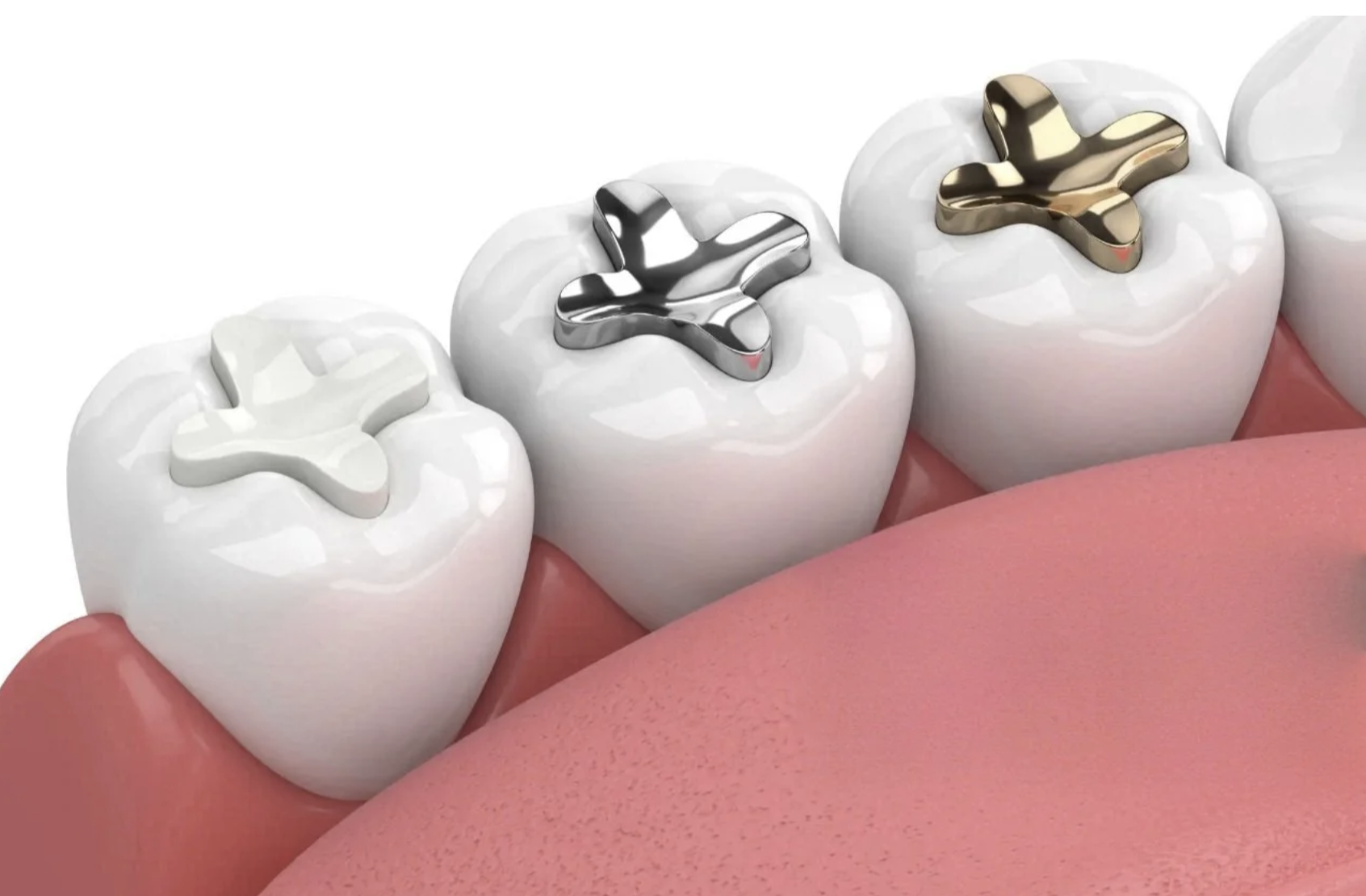 Close-up of dental crowns on molars with metallic inlays, showing a row of teeth with dental restorations.