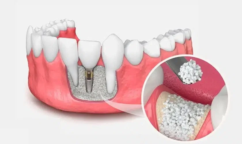 Diagram of a dental implant with a detailed inset showing bone graft material in the jaw.