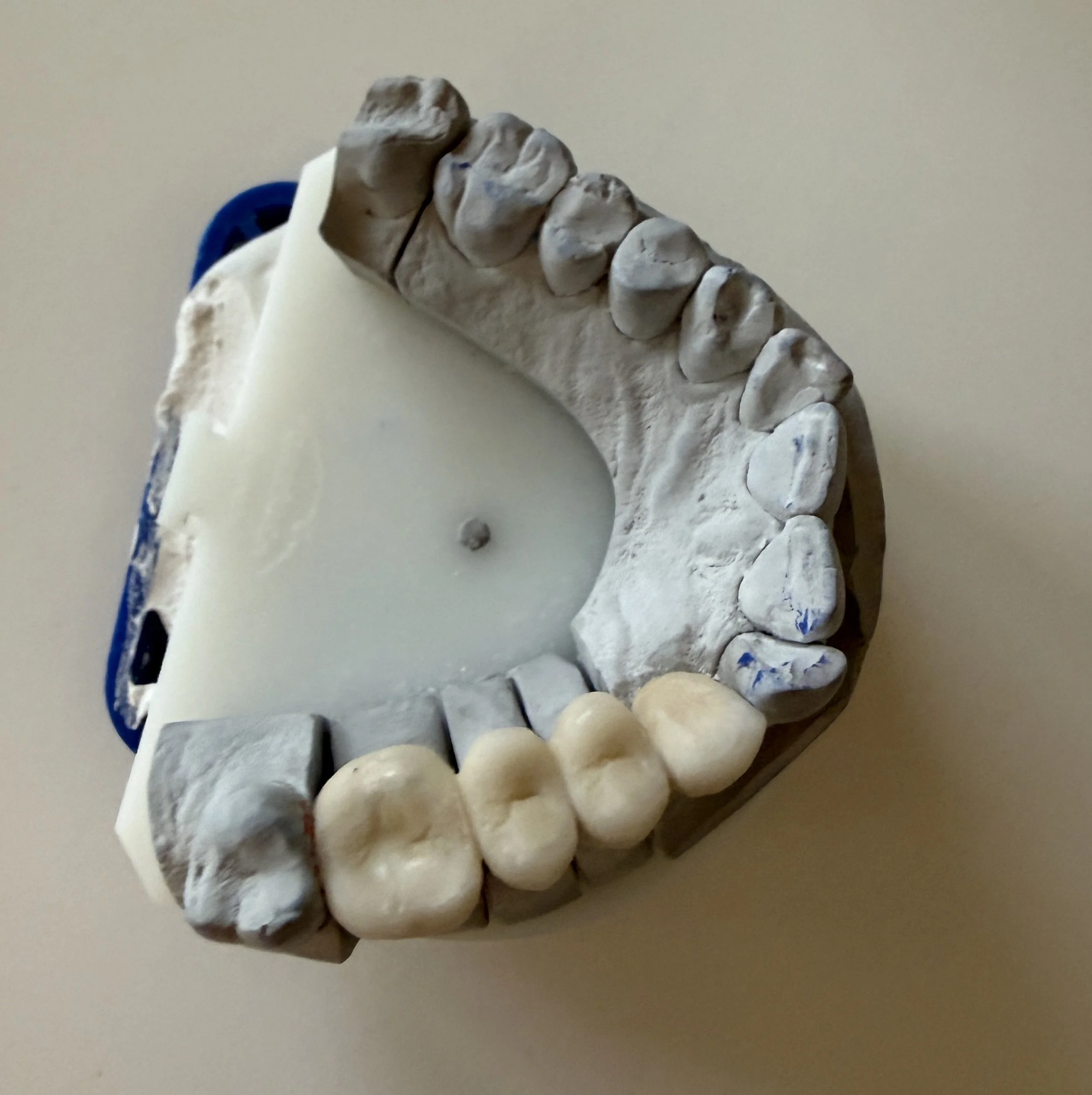 Dental cast mold of upper teeth with some artificial teeth and a small metal component.