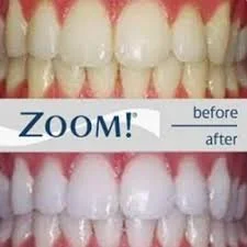 Close-up of a person's teeth showing a before and after teeth whitening comparison.