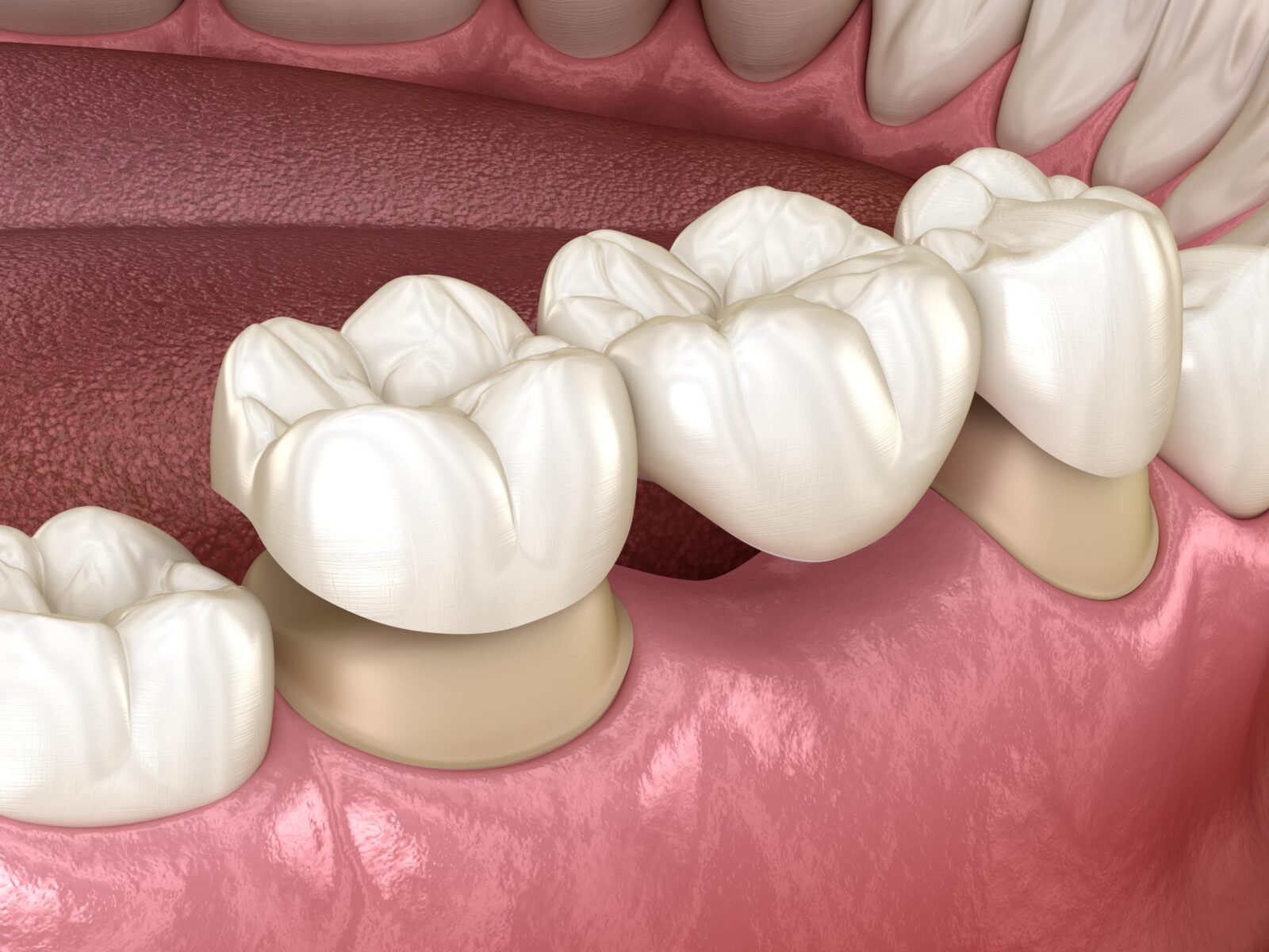 A detailed digital illustration of a lower set of teeth with some dental crowns or veneers, showing the gums and inner mouth.