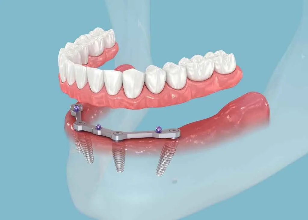 Digital illustration of a dental implant with a set of upper teeth and a lower jaw attachment, showing dental screws.